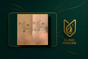 حذف تاتو با کیوسوئیچ