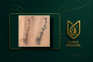 قبل و بعد حذف تاتو در کلینیک مهوان